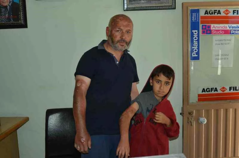 Piknik alanında yakılan çöpler patladı: 1’i çocuk 2 yaralı
