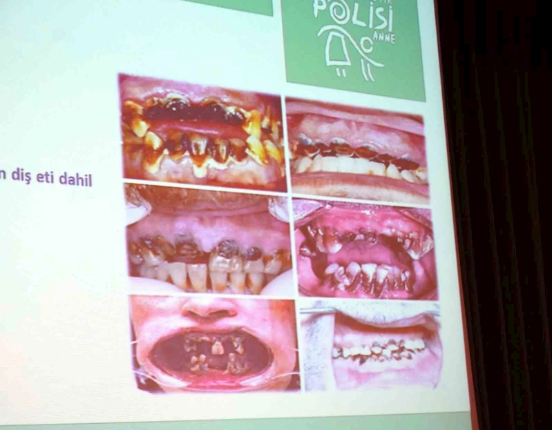 Metamfetamin kullanan bağımlıların ağız ve dişleri görenleri korkuttu
