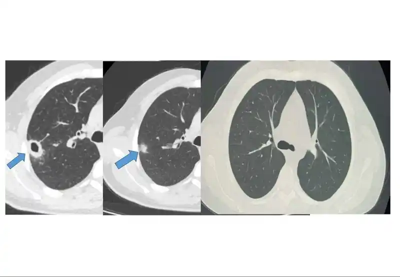 Bayburt’ta 50 yaşındaki hasta erken tanıyla sağlığına kavuştu
