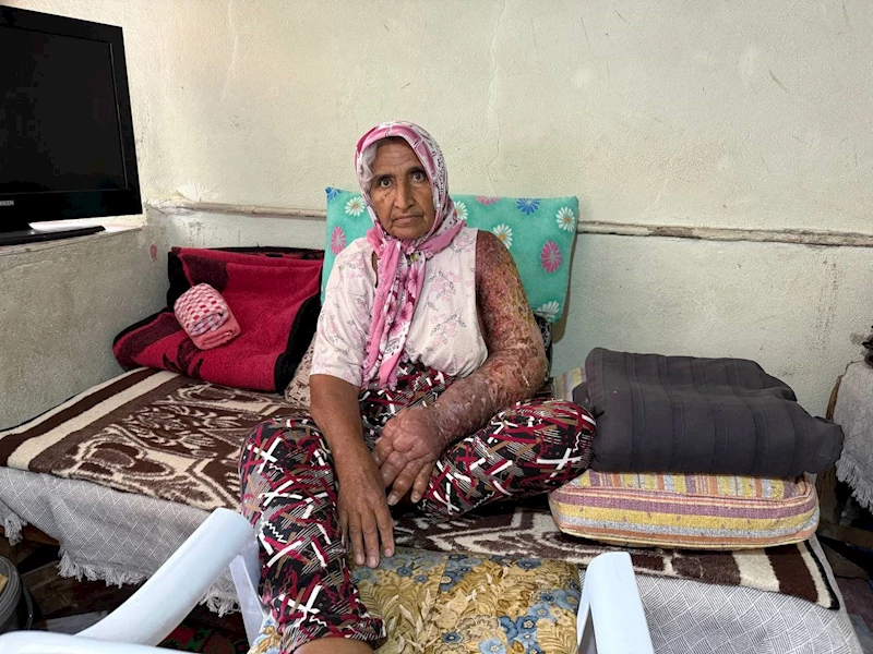 Kolu şişti, vücuduna kadar yara oldu: 4 çocuk annesinin zorlu yaşamı
